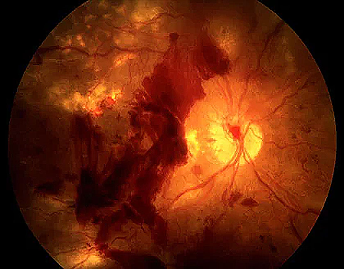 7 Facts About Vision Loss Due To Diabetes from M&M Eye Institute
