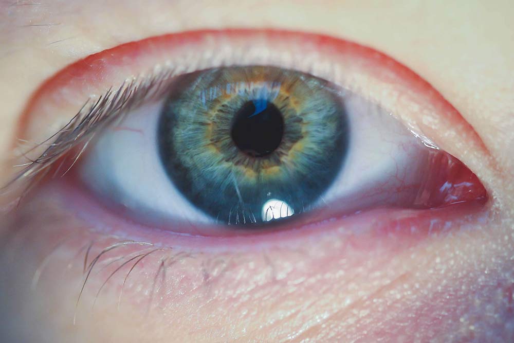 Upclose shot of blue eyes during allergy season.