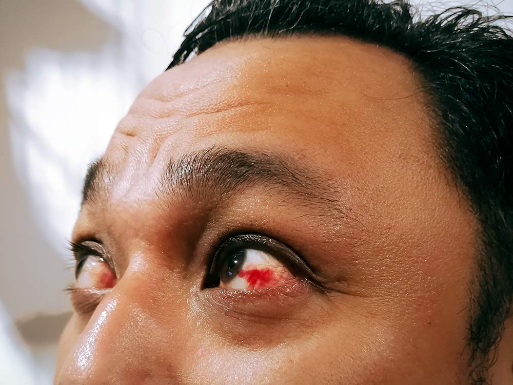 Man with red eyes or an eye infection.