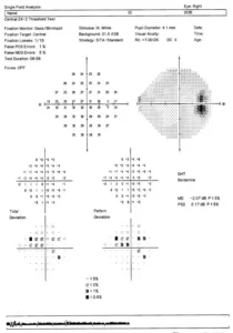 what-do-glaucoma-test-results-mean at M&M Eye Institute