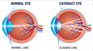 What is a cataract? Cataract diagram designed by M&M Eye Institute in Prescott, Arizona.