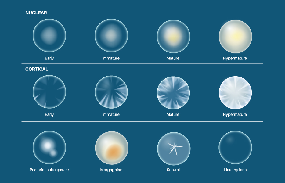Illustration showing the progression and types of cataracts.