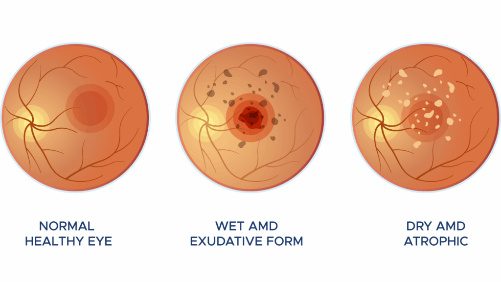 Three eye diagrams showing a normal retina, wet AMD with a central lesion and exudates, and dry AMD with retinal atrophy.