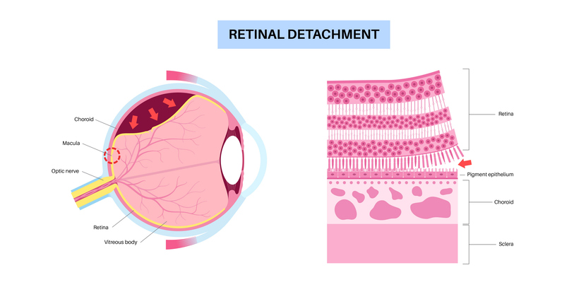 Diagram of retinal detachment and the layers of the eye.