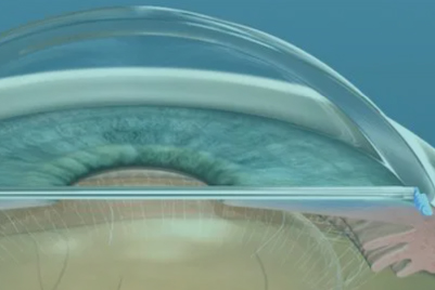 MIGS surgery image
