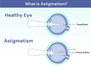 Astigmatism Treatment diagram at M&M Eye Institute.