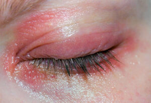 Blepharitus treatment for eyelid inflamation like this at M&M Eye Institute in Prescott, Arizona.
