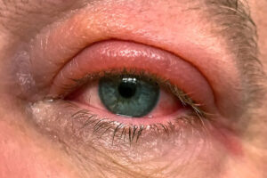 Inflammation of the eyelids, known as blepharitis, is another cause of eyelid itchiness, find treatment at M&M Eye Institute.