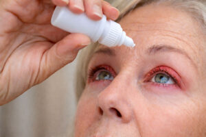 Eye drop treatment to help with dry eye, a leading cuase of itchiness on the eyelids, find treatment at M&M Eye Institute.